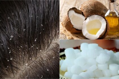 Dandruff will be eliminated by using coconut oil and camphor in this manner;  Dry hair will get velvet like shine - India TV Hindi