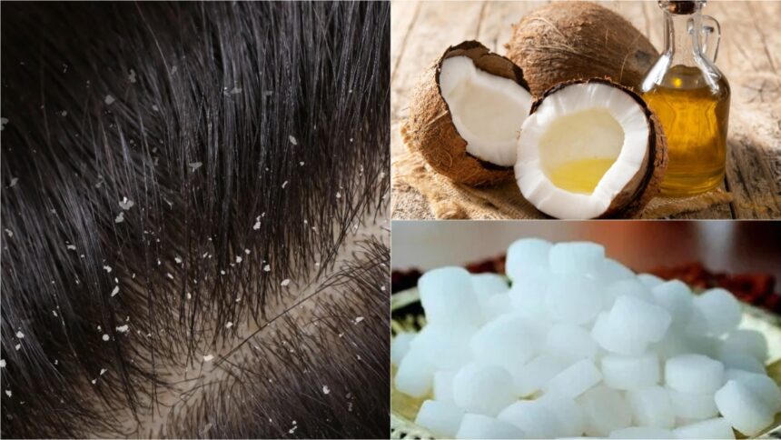 Dandruff will be eliminated by using coconut oil and camphor in this manner;  Dry hair will get velvet like shine - India TV Hindi