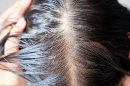 Hair also starts falling due to PCOS, know how to take care of hair in this condition?  - India TV Hindi