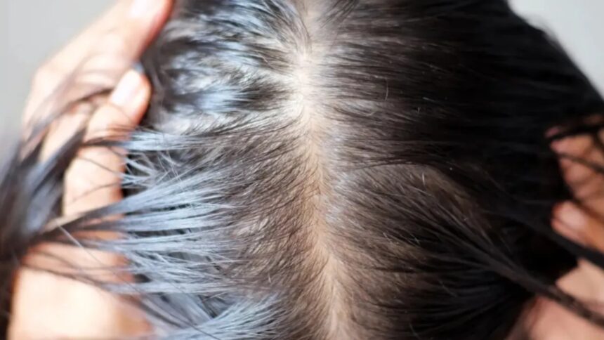 Hair also starts falling due to PCOS, know how to take care of hair in this condition?  - India TV Hindi