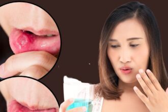 Mouth Ulcer: Is the mouth filled with ulcers?  These 5 big reasons can be responsible, know the symptoms and prevention methods from the doctor