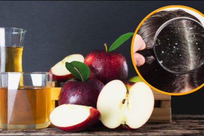 Unique treatment for dandruff problem, use apple cider vinegar for hair like this - India TV Hindi