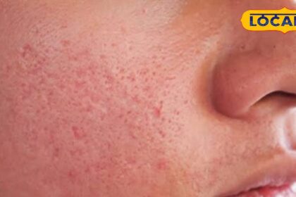 You also have the problem of open pores, expert told easy solution, know the treatment