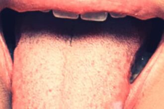 Do you also have such white spots on your tongue?  Be alert immediately, this is a sign of a dangerous disease, know everything!