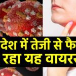 Have you lost your appetite along with headache and fever?  This virus may attack, cases increase in Delhi-NCR