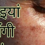 Not a cream worth thousands, this thing of Rs 10 is a panacea for facial freckles, adopt these 4 remedies immediately
