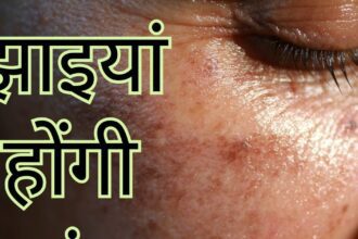 Not a cream worth thousands, this thing of Rs 10 is a panacea for facial freckles, adopt these 4 remedies immediately