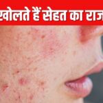 What does it mean to have pimples on different parts of the face? Know which health problems these indicate
