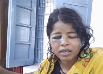 Madhya Pradesh: Accused of putting acid in the girl's eye, the administration started investigation
