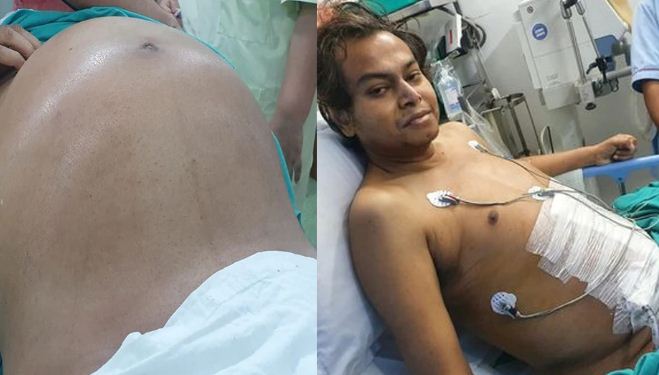 The stomach of the young man was growing continuously for 2 months, the surprising truth came to the fore