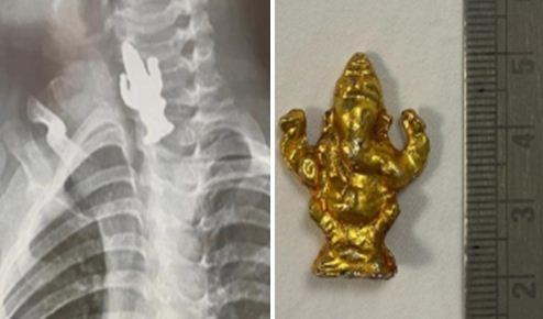 3 year old child swallows Lord Ganesha idol in Karnataka, doctors saved him alive