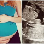 Shocking case surfaced, woman became pregnant again in just 3 weeks