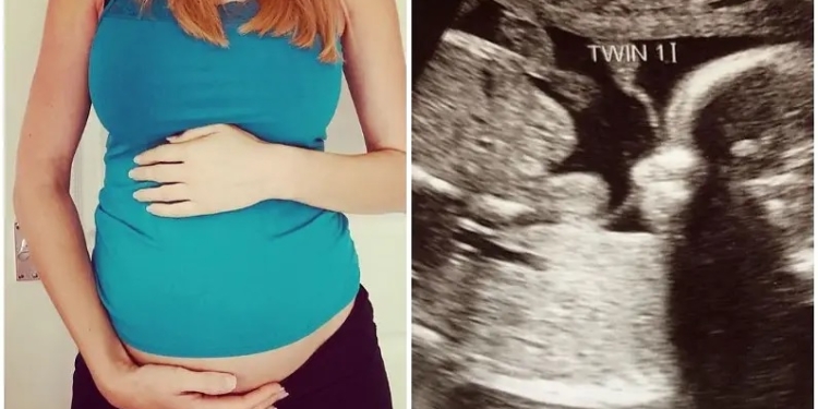 Shocking case surfaced, woman became pregnant again in just 3 weeks