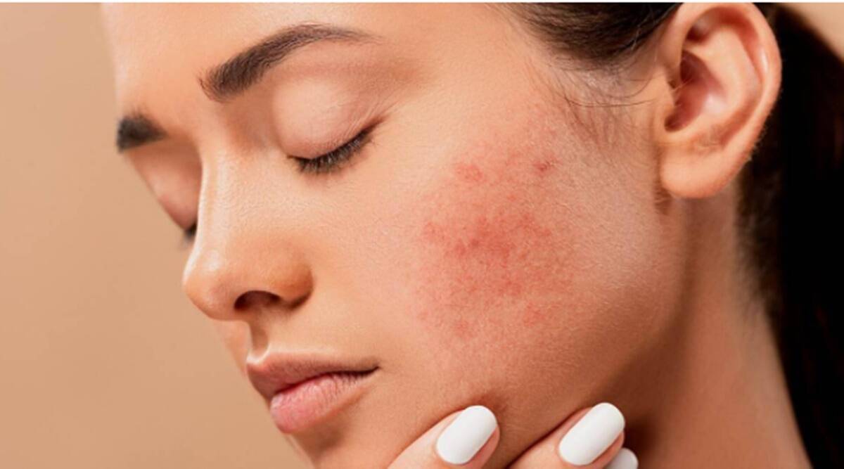 Pimples, Skin Care, Beauty Tips