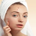 skin care tips, skin care tips,acne remove