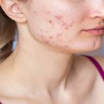 If you want to get rid of acne so apply these home remedies for your skin care routine