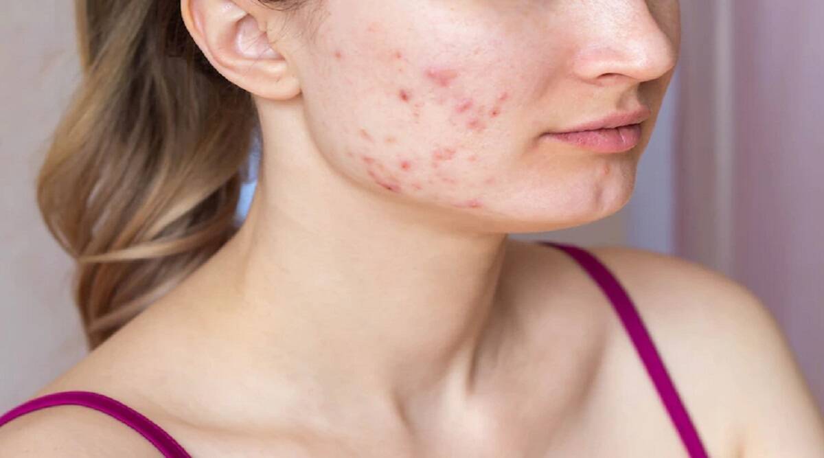 If you want to get rid of acne so apply these home remedies for your skin care routine