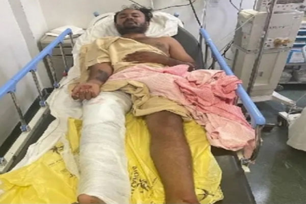 Karnataka: Acid attacker arrested, police shot him in leg while escaping - Bengaluru News in Hindi