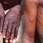 Monkeypox |  Relief news about monkeypox: Some antiviral drugs are effective, read full report