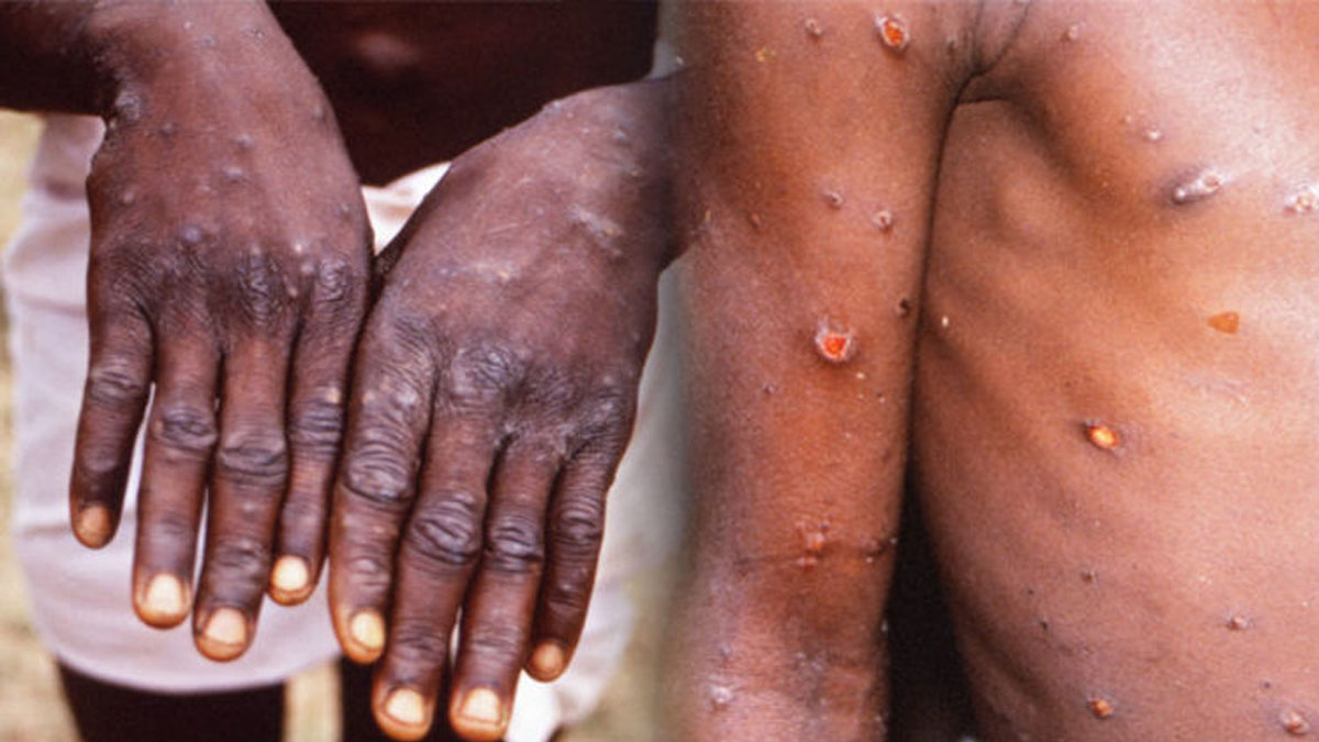 Monkeypox |  Relief news about monkeypox: Some antiviral drugs are effective, read full report