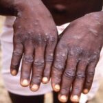 Monkeypox Virus FAQs: How to be careful with Monkeypox, Know how it spreads, treatment, expert advice and symptoms- How to be cautious with Monkeypox?  Know how it spreads, treatment and expert advice