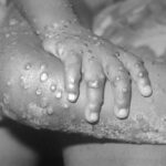 Monkeypox Virus: Is monkeypox more dangerous than chickenpox?  Learn Symptoms and Prevention