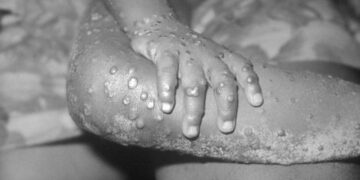 Monkeypox Virus: Is monkeypox more dangerous than chickenpox?  Learn Symptoms and Prevention