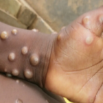 Monkeypox, a new disease spreading rapidly around the world, know how dangerous it is for India