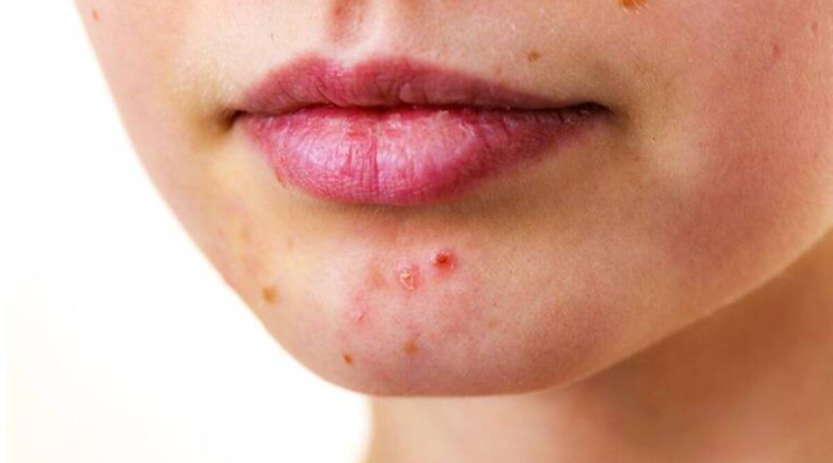 Skin Care Troubled problem of pimples You can get spotless face with these home remedies- Troubled by pimples?  You can get a spotless face with these home remedies