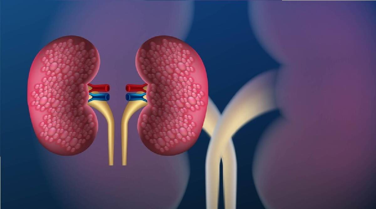 There can be four types of stones in the kidney, know the symptoms, causes and methods of prevention from expert