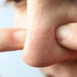 Know the best home remedies to get rid of nose blackheads and whiteheads-Skin Care Tips: If blackheads have increased on nose and chin, then remove them with these remedies