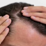 What causes baldness in men?  Know the reason and home remedies to cure it-Hair Care