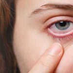 Dark Circles Removal Tips: Due to these reasons, dark circles occur under the eyes, know home remedies to get rid of them