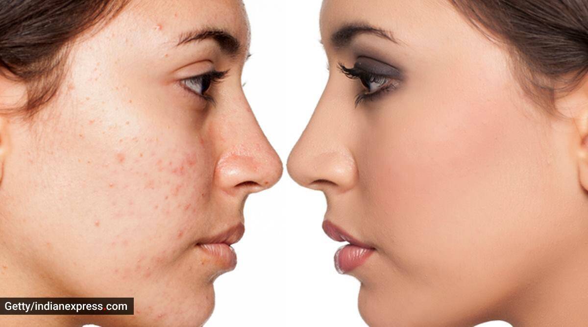 Troubled by acne skincare routine should be like this in summer eat this for good skin - Skin Care:  Know how skincare routine should be in summer
