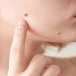 know the 3 best home remedies to Remove Moles and Warts  Learn ways to get rid of them sitting at home