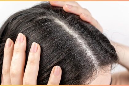 Are you troubled by flaky dandruff?  Adopt these 3 home remedies without wasting time