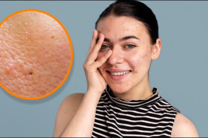 The biggest cause of acne and dirt is open pores, how to close the pores