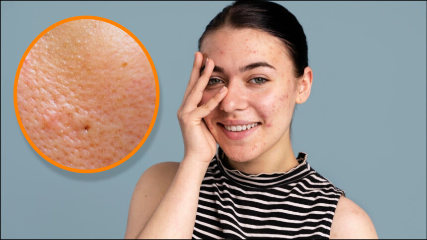 The biggest cause of acne and dirt is open pores, how to close the pores