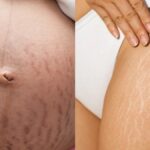 Due to these reasons, stretch marks appear on the body, these tips help in clearing this skin stain - India TV Hindi
