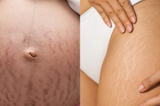 Due to these reasons, stretch marks appear on the body, these tips help in clearing this skin stain - India TV Hindi