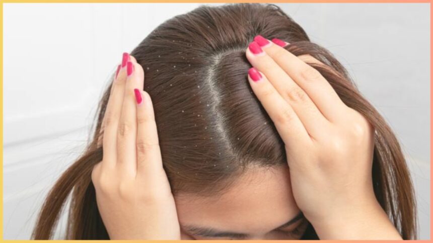 Got rid of dandruff!  Try these home remedies suggested by experts yourself - India TV Hindi