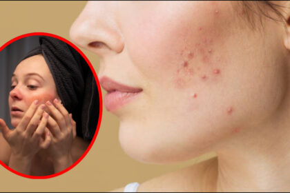 Pimples have appeared on the face and skin has turned red while trying to remove color, adopt these remedies - India TV Hindi