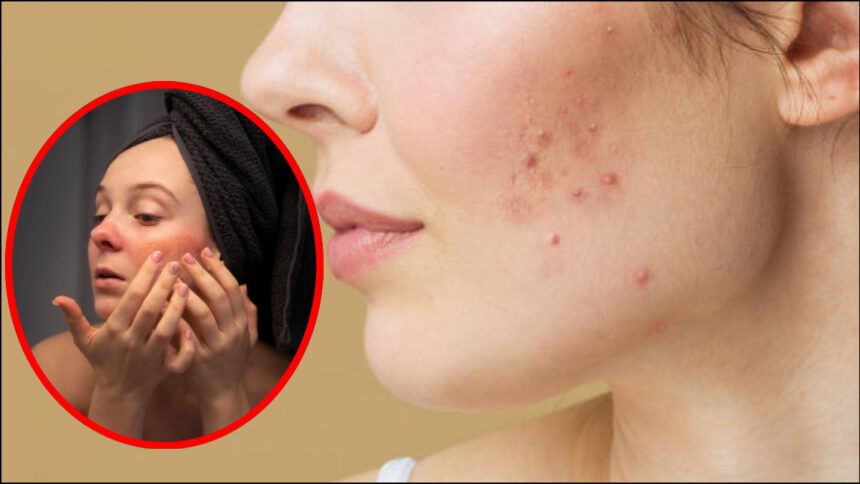 Pimples have appeared on the face and skin has turned red while trying to remove color, adopt these remedies - India TV Hindi