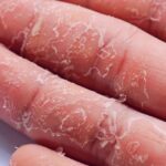 The skin of hands and feet is peeling off, these could be the major reasons, get rid of it with 5 measures, the skin will become soft again.