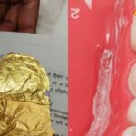 There are big benefits of getting gold teeth fitted, if you also want to get it fitted then know the price.