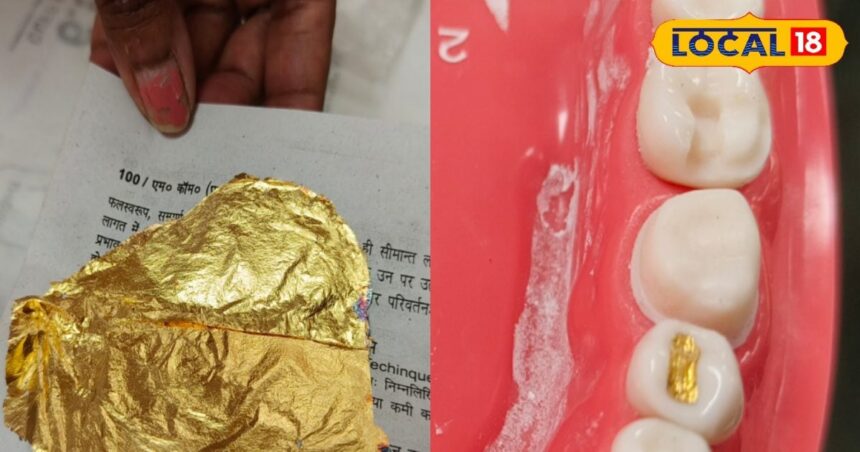 There are big benefits of getting gold teeth fitted, if you also want to get it fitted then know the price.