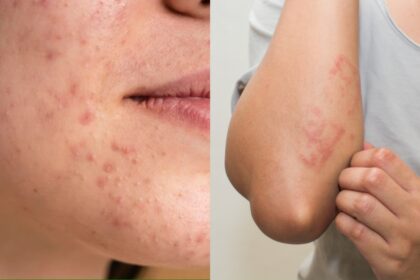 These remedies are effective in getting rid of skin allergies and rashes, you will get relief as soon as you try them - India TV Hindi