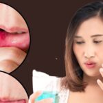 Mouth Ulcer: Is the mouth filled with ulcers?  These 5 big reasons can be responsible, know the symptoms and prevention methods from the doctor
