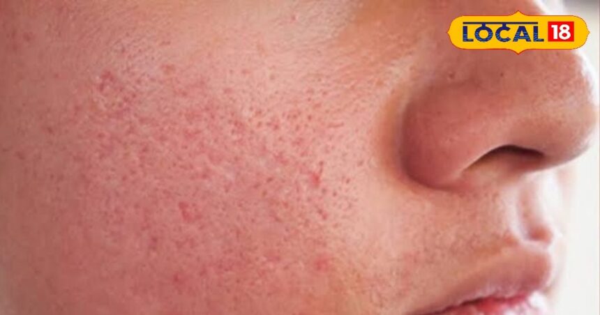 You also have the problem of open pores, expert told easy solution, know the treatment