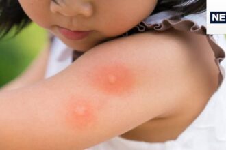 Dengue is more dangerous for children than adults, death occurs quickly, these 5 things are responsible